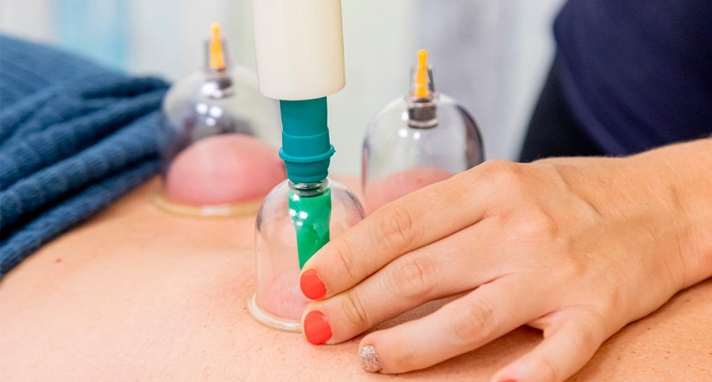 El cupping o massatge amb ventoses